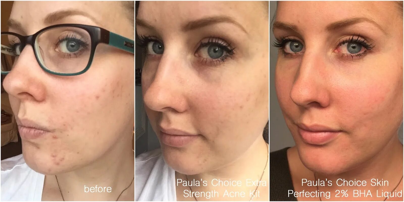 Ретинол до и после отзывы Glycolic Acid Chemical Peel Pure Strength Aha 10% 20% 30% 40% 50% 60% 70% 1oz Fr