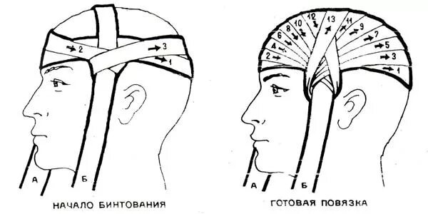 Повязка чепец Гиппократа. Повязка чепец техника. Техника наложения повязки чепец. Перевязка головы бинтом чепец. Как перевязывать голову