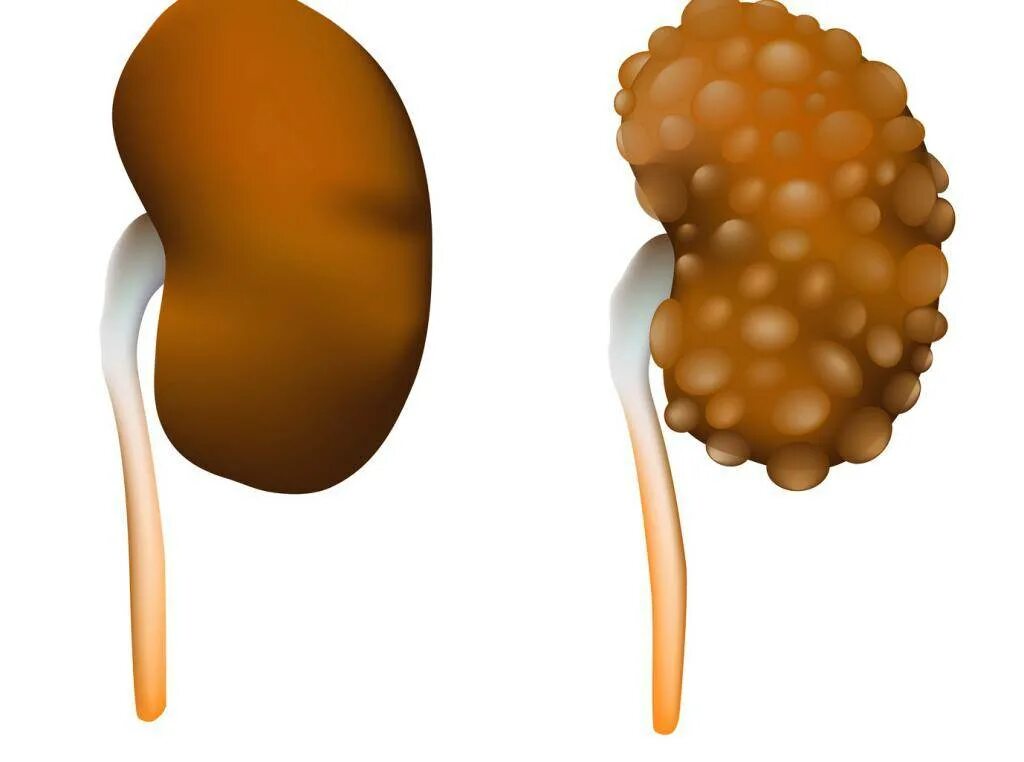 Кисты на почках и поликистоз почек. Кисты в почках поликистоз. Врожденный поликистоз почек.