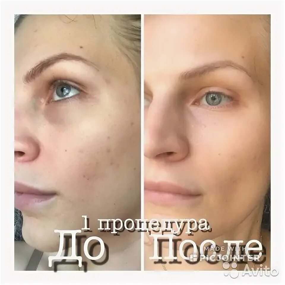 Бибиглоу. Вв глоу эффект тонального крема. Эффект тонального крема на год отзывы. Эффект би би глоу. Вв глоу эффект тонального крема.