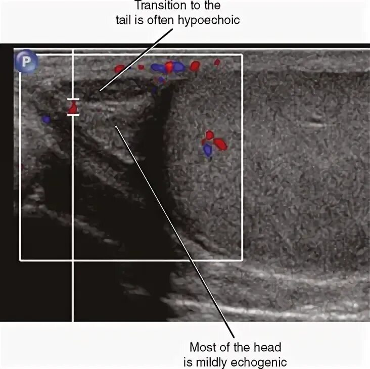 УЗИ органов мошонки норма. Нормы ультразвукового исследования мошонки. Образование придатка яичка УЗИ. УЗИ мошонки Диагностер. Размеры придатков яичек