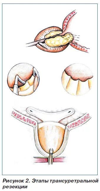 трансуретральная резекция. осложнения при трансуретральной резекции. тур трансуретральная резекция простаты. трансуретральная аденомэктомия. трансуретральная резекция аденомы простаты техника.