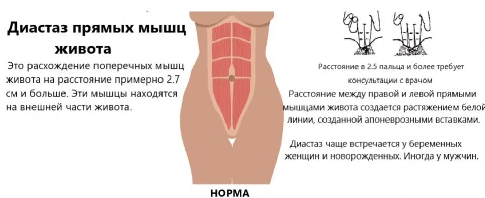 Уменьшение диастаза