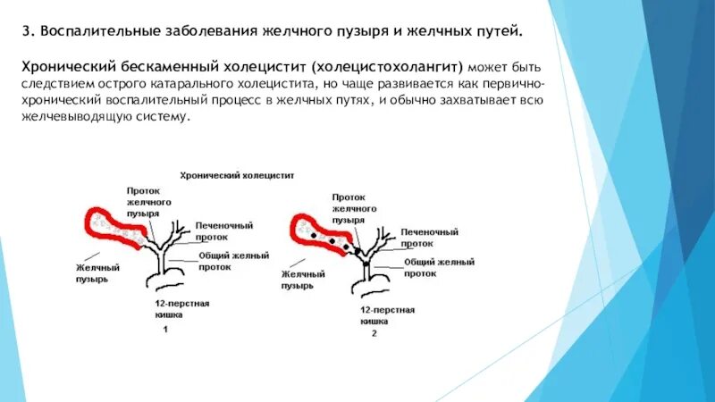 Болезни желчного пузыря и желчевыводящих. Синдромы поражения желчного пузыря. Заболевание желчного пузыр. Классификация заболеваний желчного пузыря и желчевыводящих путей. Хронические заболевания желчевыводящих путей.