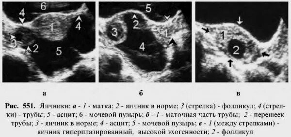 Размеры яичника по УЗИ В норме. Размер яичника в норме у женщин УЗИ. Объем яичников в норме на УЗИ. УЗИ+норма+фолликулярные+яичники. Норма правого яичника