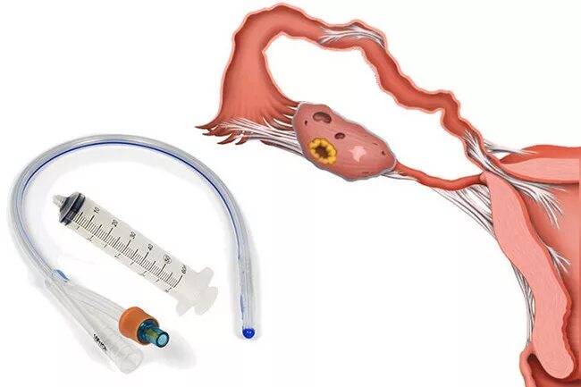 Гсг непроходимость маточных труб. Окклюзия маточных труб. Маточные трубы эстетика. Непроходимость труб симптомы. Сальпингография маточных труб.