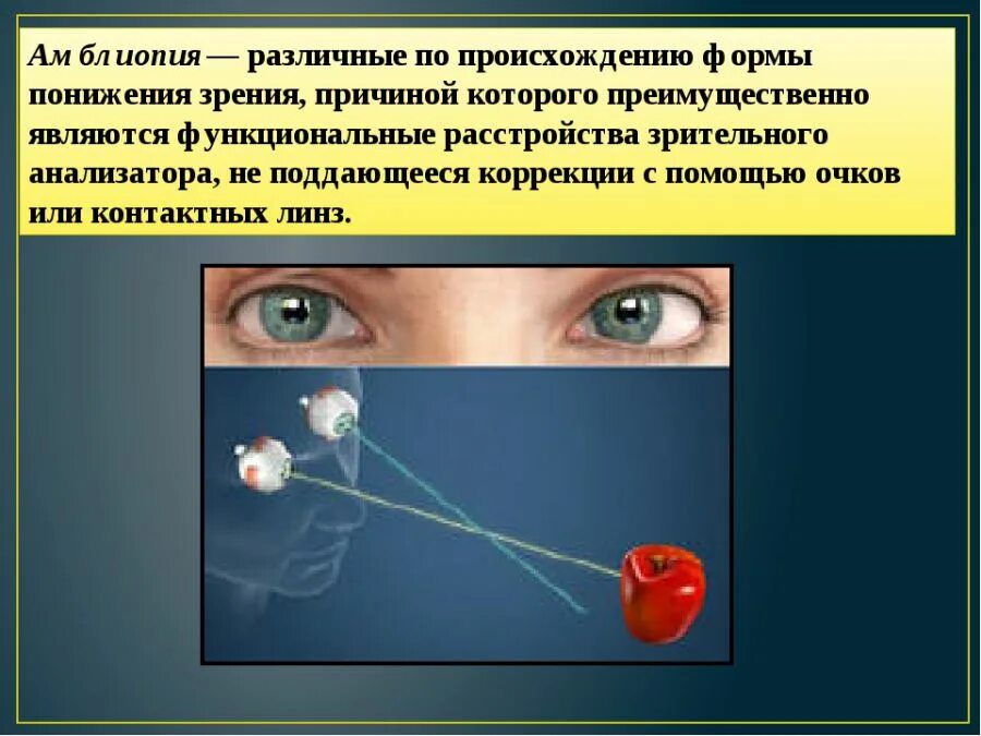 Амблиопия степени у взрослых. Косоглазие и амблиопия. амблиопия ленивый глаз. заболевание глаз амблиопия у взрослых. нарушение центрального зрения.