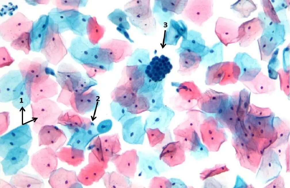 воспалительный мазок nilm