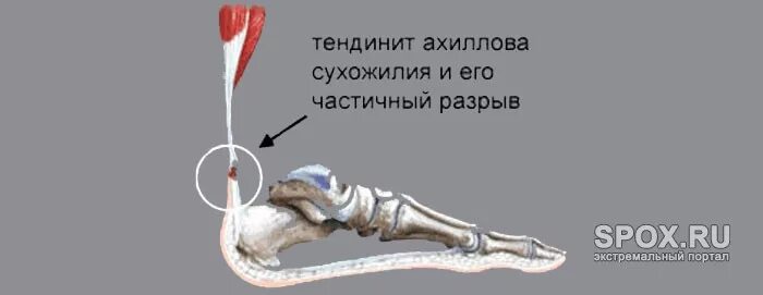 Ахиллово сухожилие разрыв ахиллова сухожилия. Тендинит пяточного сухожилия. Надрыв связок ахиллова сухожилия. Частичный разрыв связок ахиллова сухожилия. Разрыв связок ахиллова сухожилия симптомы.