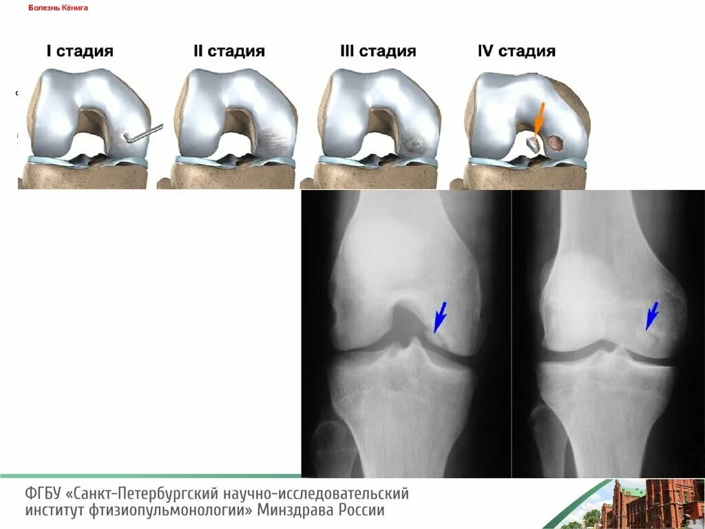 Хондромаляция медиальных мыщелков. Болезнь Кенига артроскопия. Остеохондропатия бедренной кости Кенига. Болезнь Кёнига рассекающий остеохондрит.