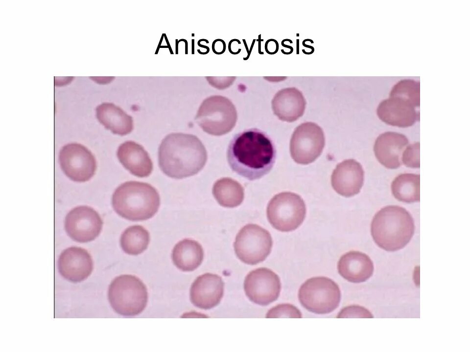 Анизоцитоз эритроцитов. Анизоцитоз лейкоцитов. Микроцитоз макроцитоз анизоцитоз. Микроцитоз макроцитоз анизоцитоз пойкилоцитоз.