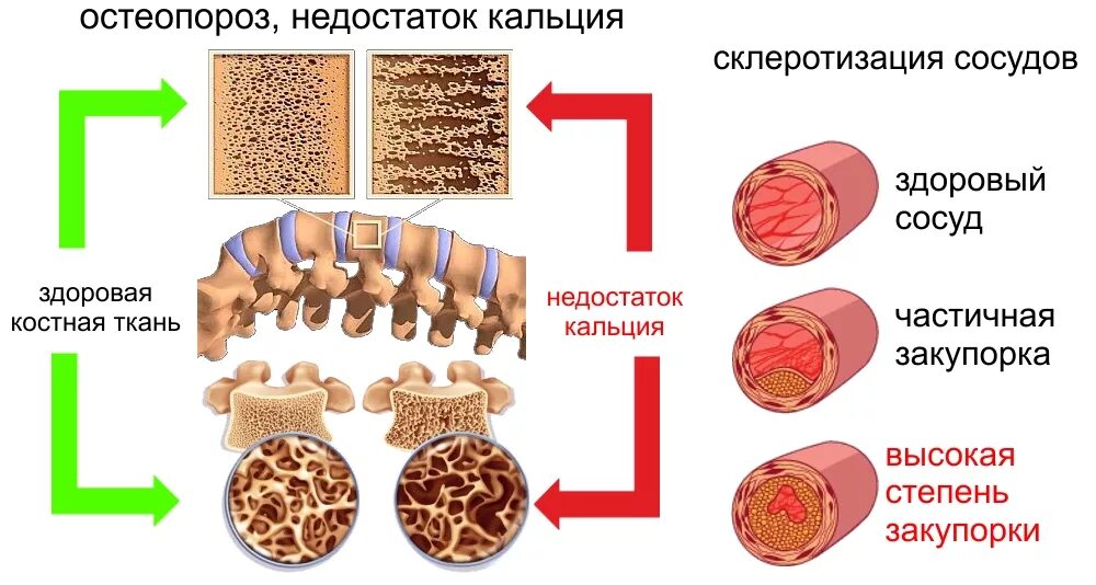 Не хватает кальция в организме. Болезни, возникающие при нехватке кальция. избыток и недостаток кальция в организме человека. заболевания связанные с недостатком кальция. дефицит и избыток кальция в организме.
