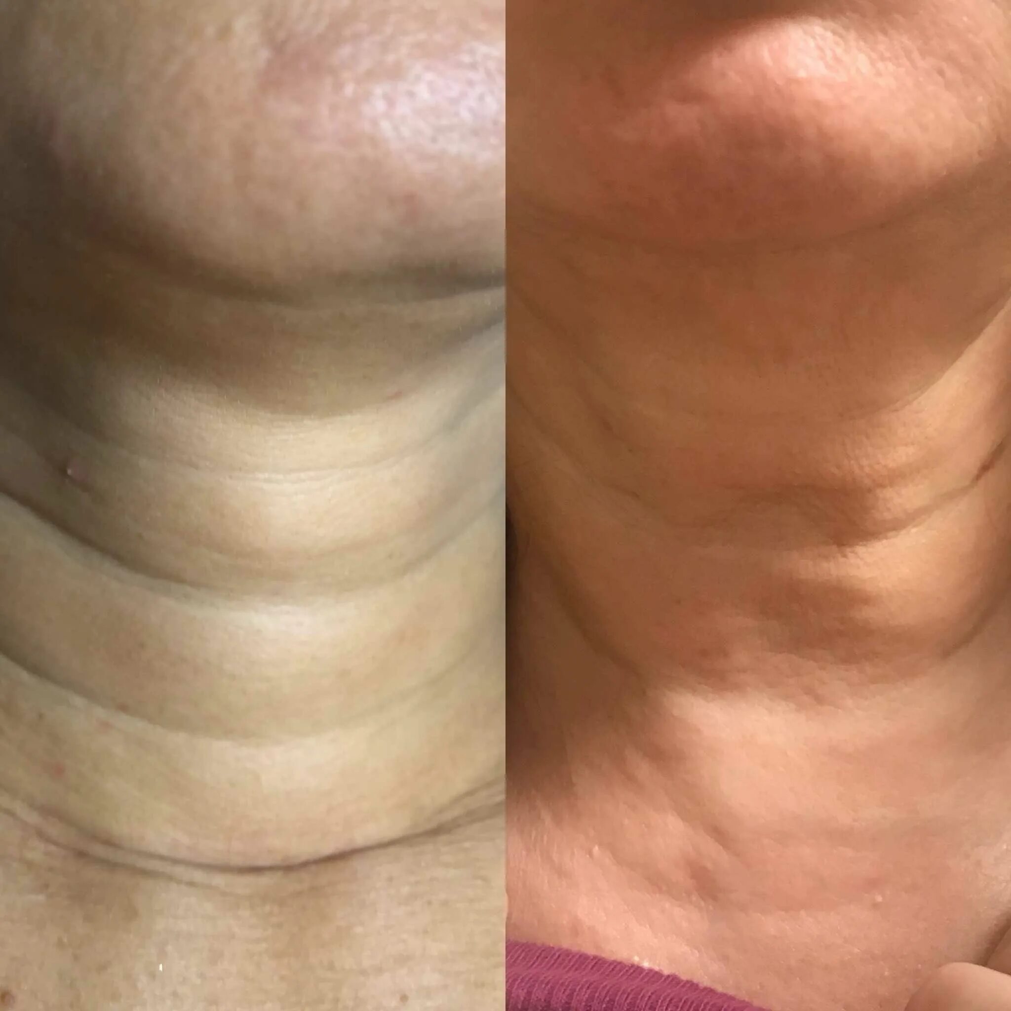 Как убрать морщины на шее. Кольца венеры на шее причины. Как убрать морщины на шее. Кольца венеры платизма. Складки на шее кольца венеры.