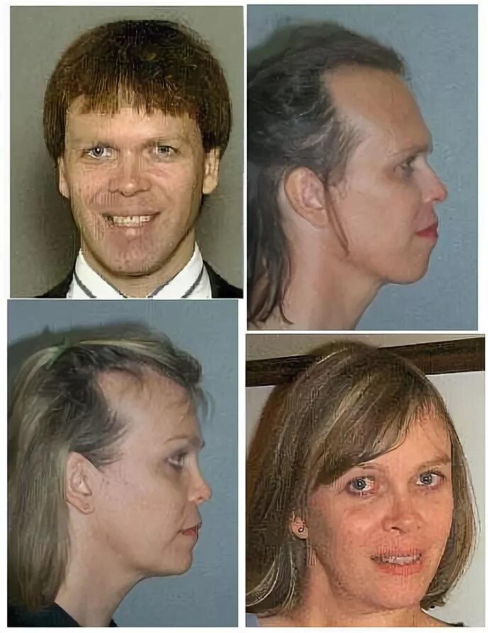 Противозачаточные таблетки побочные эффекты. Последствия после гормональных. Последствия после гормональных. Проявления пангипопитуитаризма. Таблетки гормональные противозачаточные противопоказания.