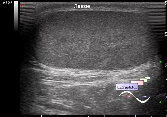 Воспаление семенного канатика у мужчин. Перекрут яичка УЗИ картина.