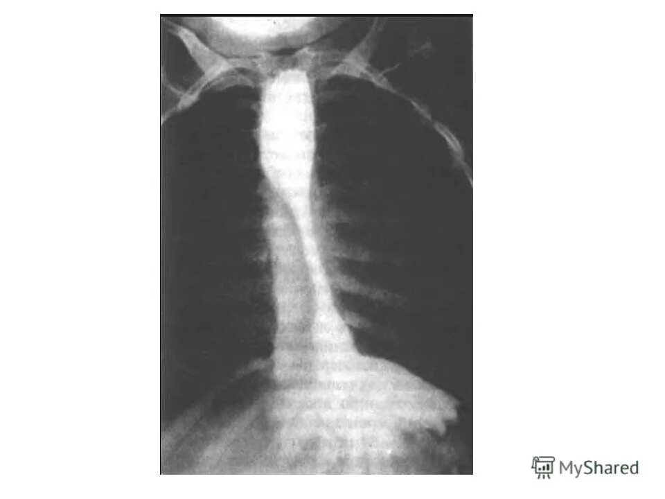 Стриктура пищевода клиника. Врожденный короткий пищевод рентген. Врожденный стеноз пищевода. Врожденное укорочение пищевода.