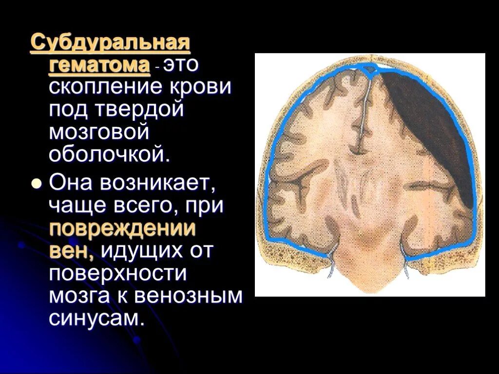 Черепно-мозговая гематома субдуральная. Субдуральная гематома головного мозга. Субгалеальная гематома. Субхореальная гематома.