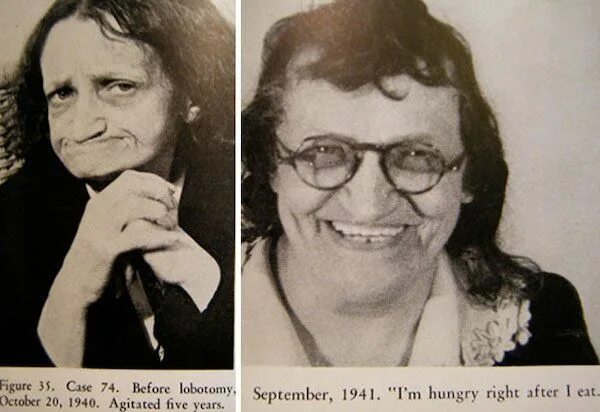 Фотографии пациентов с лоботомией. Часть вторая История Всего Дзен