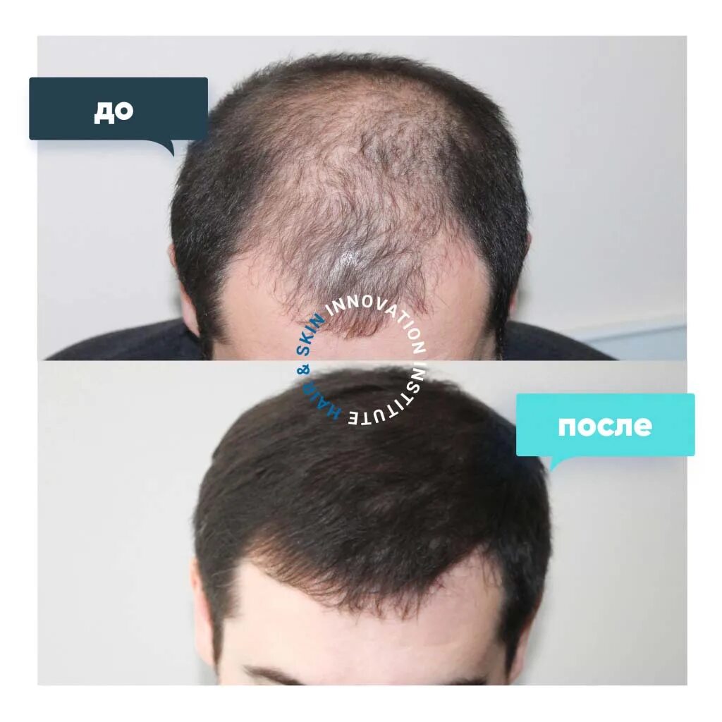Hfe пересадка. Пересадка волос до и после. ХЕСУС до пересадки волос и после. Бебуришвили до и после пересадки волос.