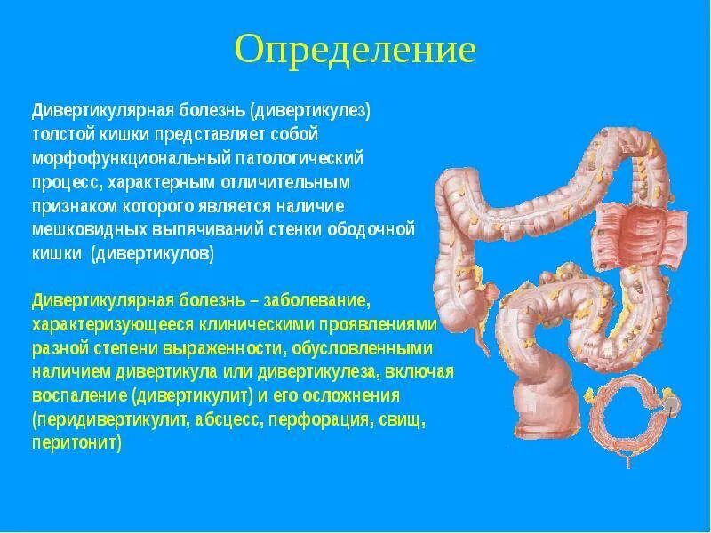 Нарушение кишечника. Сигмовидная толстого кишечника. сигмовидная кишка анатомия. что такое дивертикулит толстого кишечника. дивертикулы сигмовидной кишки.