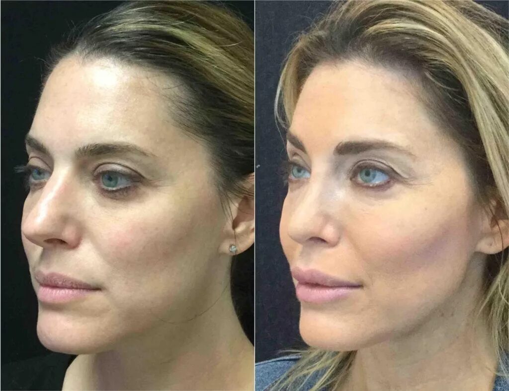 кэрол маджио нос до и после. скулы до и после. пластика скул радиесс. андреищев малярпластика. эффект скул.