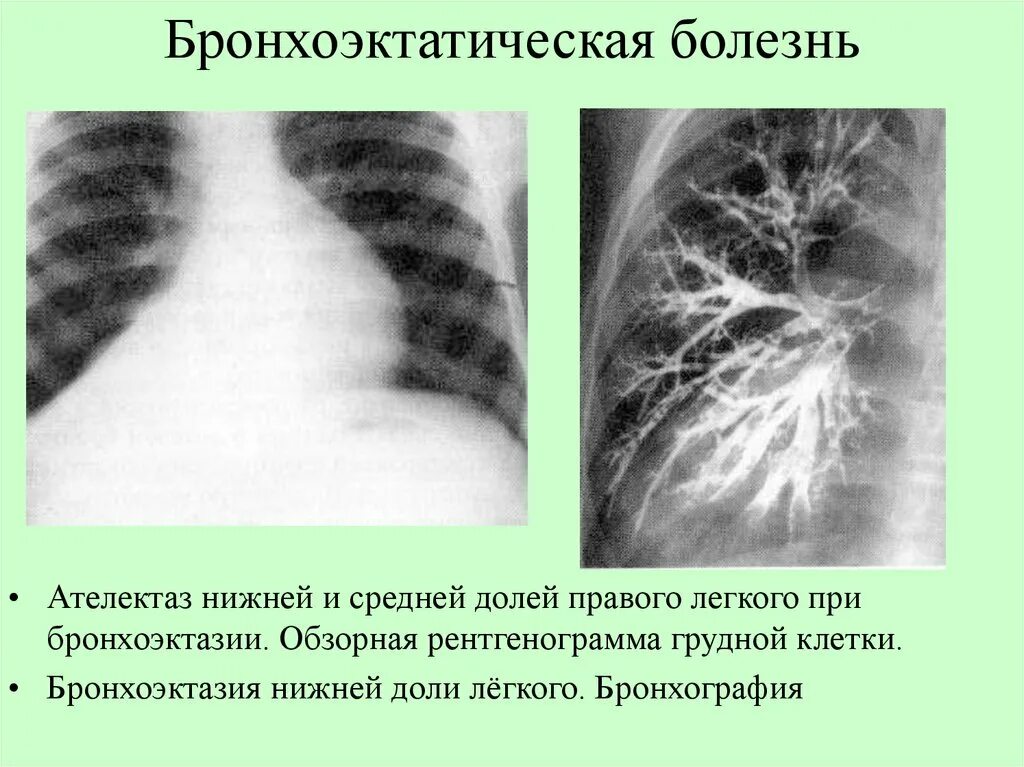 Бронхит бронхоэктатическая болезнь. Бронхоэктатическая пневмония. Рентген грудной клетки бронхоэктатическая болезнь. Бронхоэктатическая болезнь:бронхоэктатическая болезнь. Бронхоэктатическая болезнь легкого рентген.