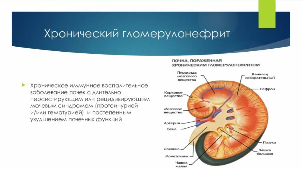 Хронический гломерулонефрит почка. Хронический глоумонефрит почек. Хронический гломерулонефрит макро. Поражение почечных клубочков. Поражение почек характерно для