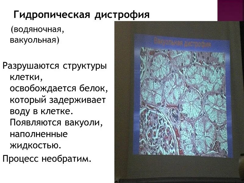 Гидропическая дистрофия патанатомия. Гидропическая дистрофия почки препарат. Гидропическая дистрофия эпителия. Гидропическая дистрофия почки макропрепарат.