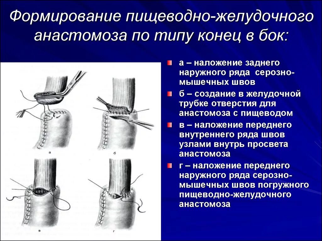 Пищеводно желудочный анастомоз. Техника наложение тонкокишечного анастомоза. Техника наложения анастомоза конец в бок. Формирование анастомоза бок в бок. Анастомоз пищевода