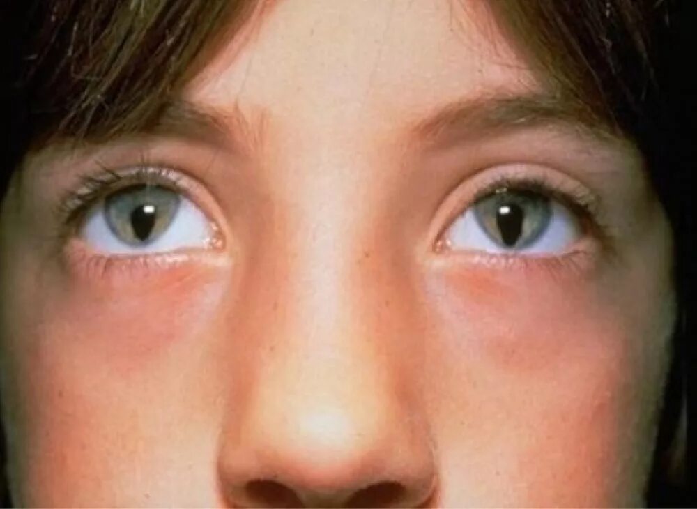 Узкие глаза признак. Врожденная колобома Радужки. Миоз мидриаз анизокория.