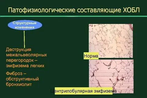 Центрилобулярная эмфизема легких