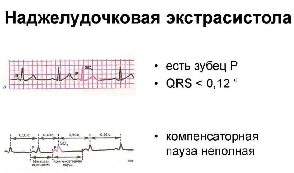 Наджелудочный экстрасистол. Наджелудочный экстрасистол. Желудочковая и наджелудочковая экстрасистолия на экг. Аберрантные экстрасистолы на экг. Супкрвентикцлярна экстрасистолия.