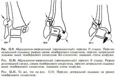 Перелом лодыжки голеностопного сустава