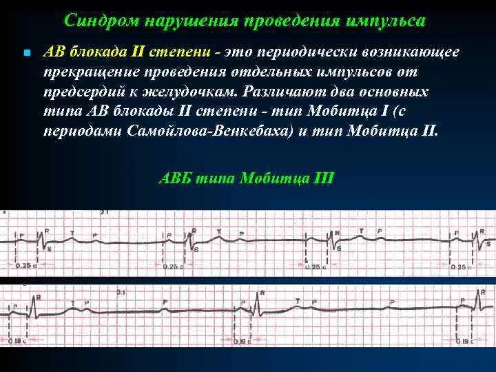 Блокады 2 степени армия. АВ блокада 3 степени синдром Морганьи Адамса Стокса. Синдромы при АВ блокаде. Далекозашедшая АВ блокада 2 степени. Блокада проведения импульса.