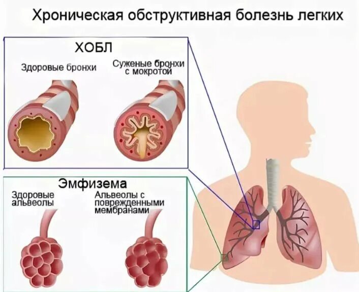 Опасное заболевание легких