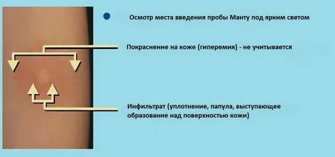 Манту норма у взрослых
