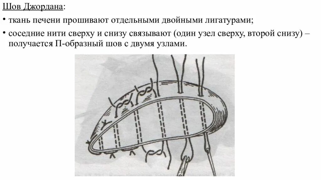 Шов паренхиматозных органов. Шов кузнецова-пенского на печени. шов оппеля на печень. матрацный шов печени.