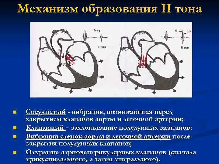 Кальциноз митрального клапана. Точка аускультации легочной артерии. Второй тон механизм образования. Клапан легочной артерии точка аускультации. Аускультация митрального клапана.