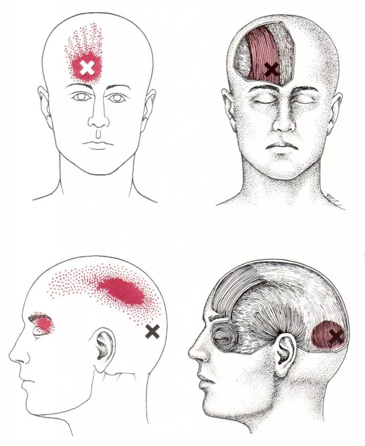 Зона лба. Триггерные точки головная боль мигрень. Болит голова триггерные точки. Триггерные точки при боли в затылке. Мышцы шеи и лица триггерные точки.