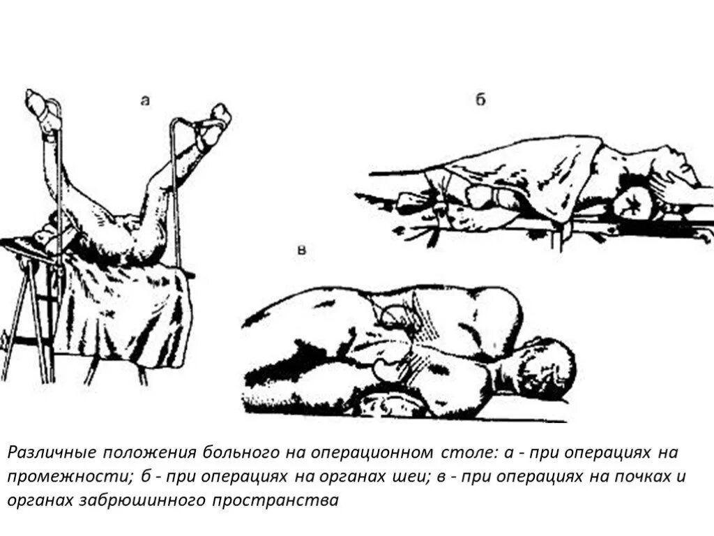 Положение больного на столе. Позиции пациента на операционном столе. Положение больного на операционном столе. Положение на операционном столе при различных операциях. Положение больного на операционном столе при различных операциях.