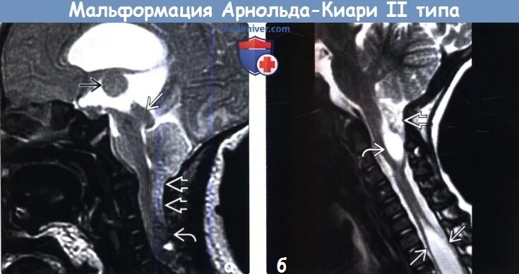 Аномалия арнольда киари что это простыми. Мальформация Арнольда-Киари 2. Мальформация Киари 2 типа мрт. Арнольда Киари аномалия степени.