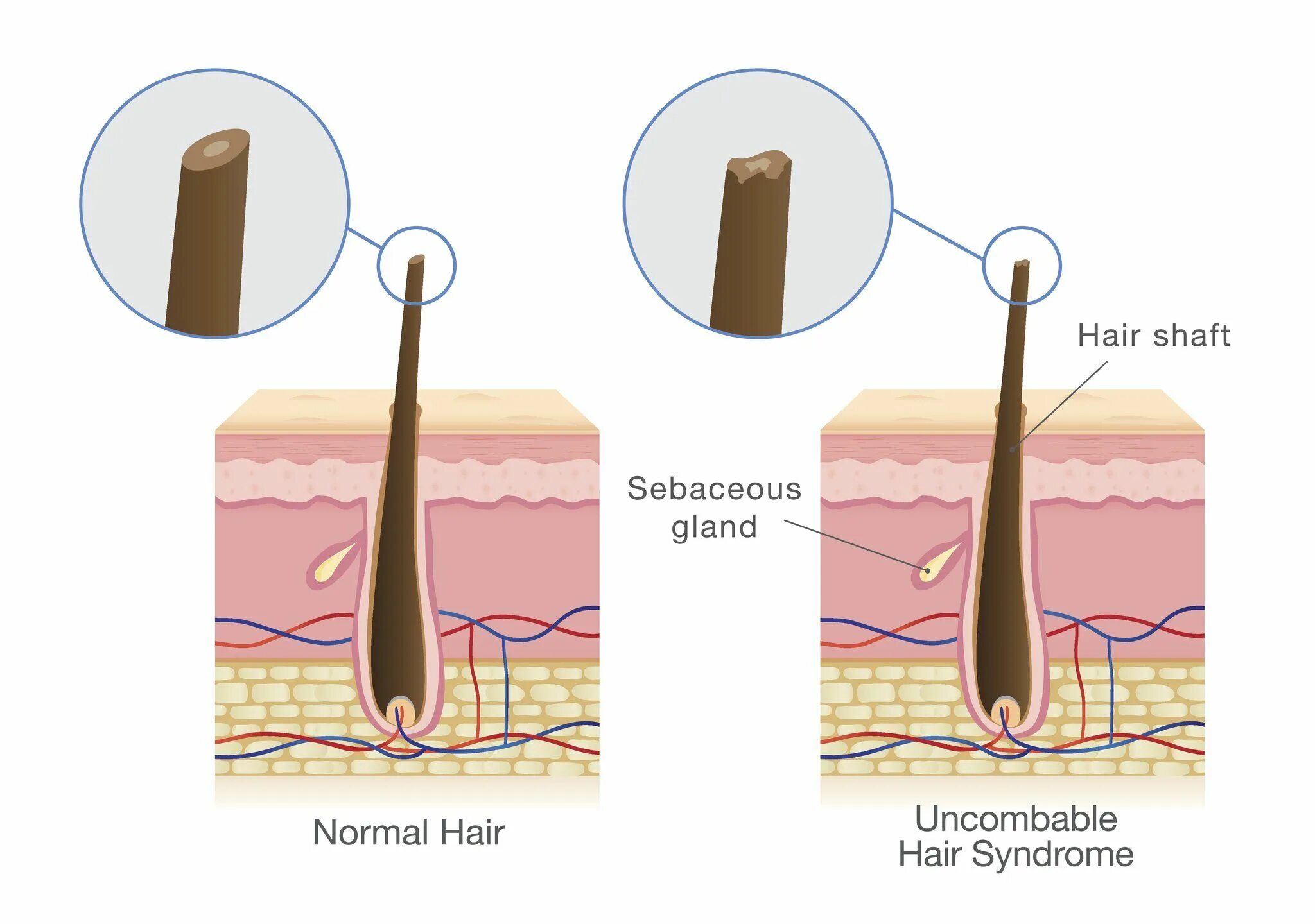 Волосы normal. Синдром нерасчесанных волос под микроскопом. Стеклянные волосы синдром.