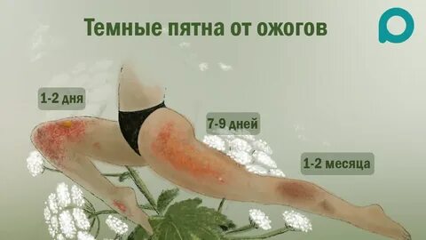 Ожог крапивой чем помазать