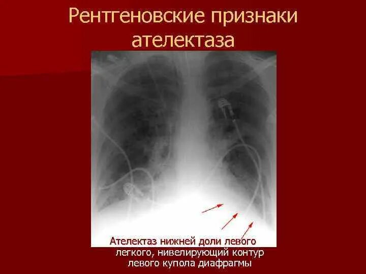 Ателектаз верхней доли рентгенограмма. Рентгенологические признаки ателектаза. Ателектаз нижней доли правого легкого рентген. Рентгенологические признаки ателектаза. Ателектаз легкого на рентге.