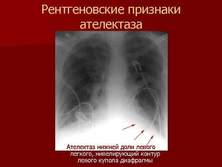 Признаки ателектаза легкого. Ателектаз легкого рентген. Сегментарный ателектаз рентген. Ателектаз средней доли правого легкого рентген. Рентген признаки ателектаза легкого.