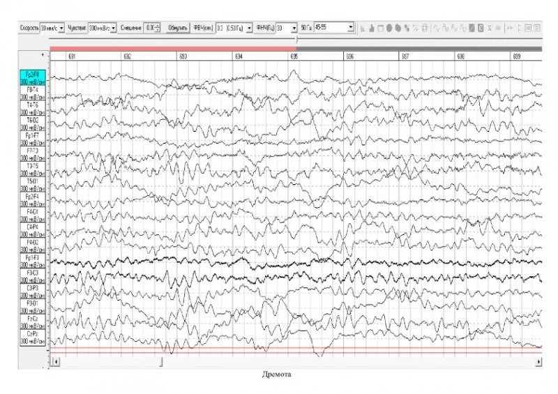 Ээг видеомониторинг сна. Норма ЭЭГ видеомониторинг. ЭЭГ ночной сон видеомониторинг. ЭЭГ мониторинг сна у детей. ЭЭГ мониторинг ночного сна у детей.