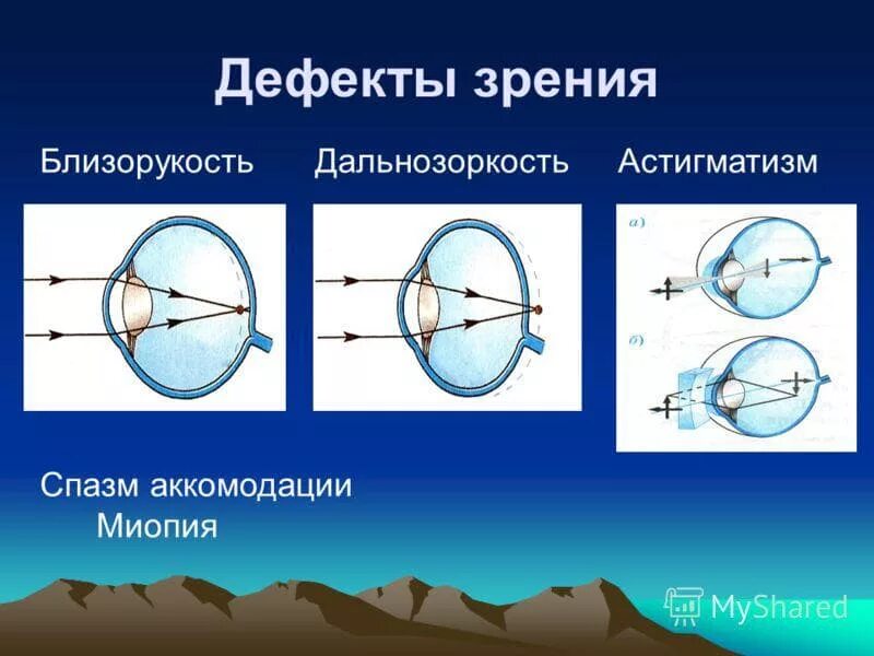 Дефекты зрения ответы. Дефекты зрения дальнозоркость и близорукость и их коррекция. Оптическая система глаза дальнозоркость близорукость астигматизм. Дефекты зрения близорукость. Миопия дальнозоркость астигматизм.