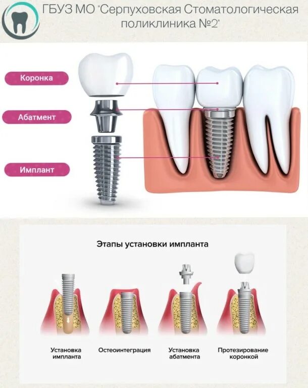 имплант зуба магнитогорск