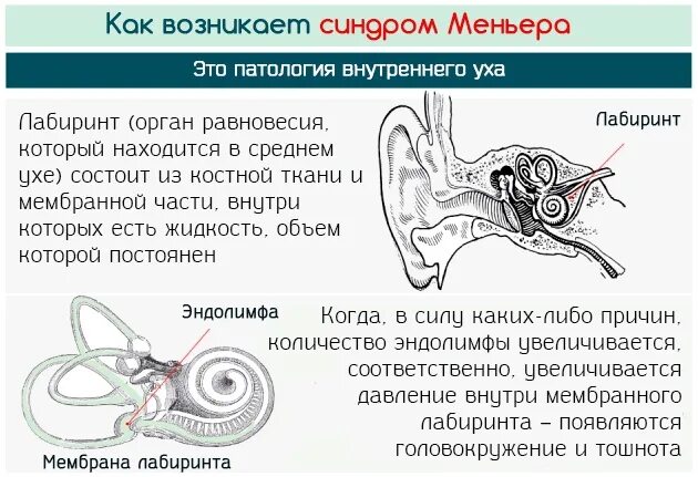 Болезни внутреннего уха Меньера. Болезнь Меньера внутреннее ухо. Заболевание внутреннего уха головокружение. Болезни внутреннего уха и головокружение.