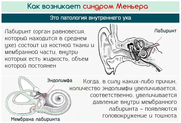 Как проверить ухо при головокружении. Болезни внутреннего уха меньера. внутреннее ухо болезнь меньера. болезни внутреннего уха и головокружение. заболевание внутреннего уха головокружение.